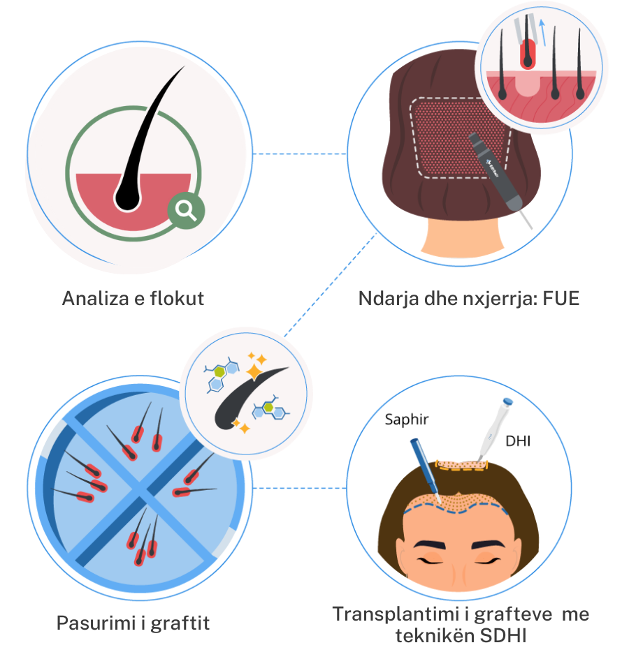 infographic showing the 4 steps of a hair transplant procedure for women