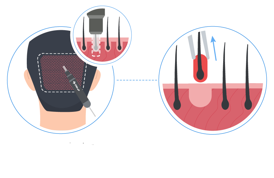 Infographic showing the hair grafts extraction from the donor area