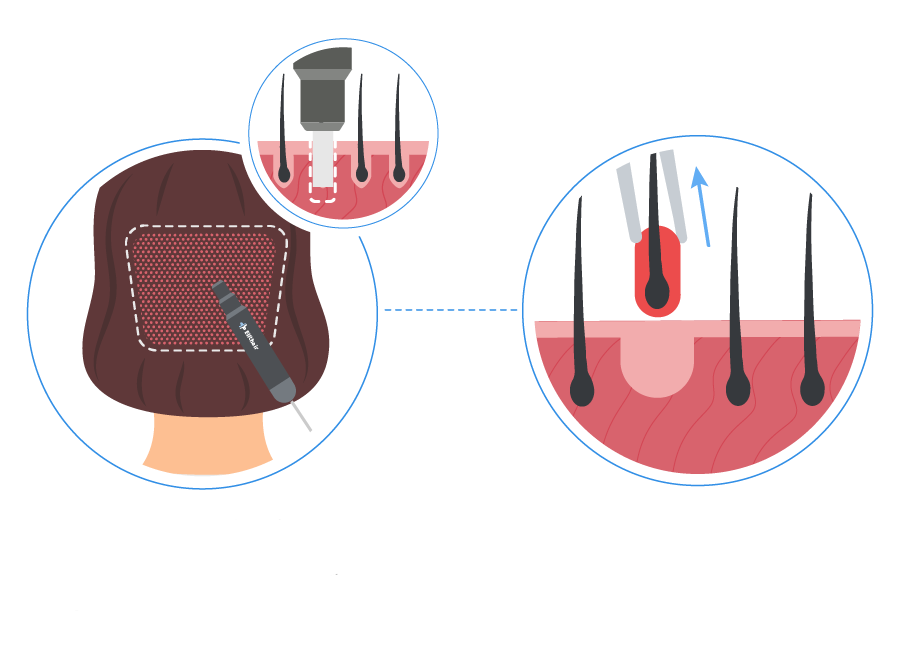 Infographic showing the hair grafts extraction from the donor area from a woman