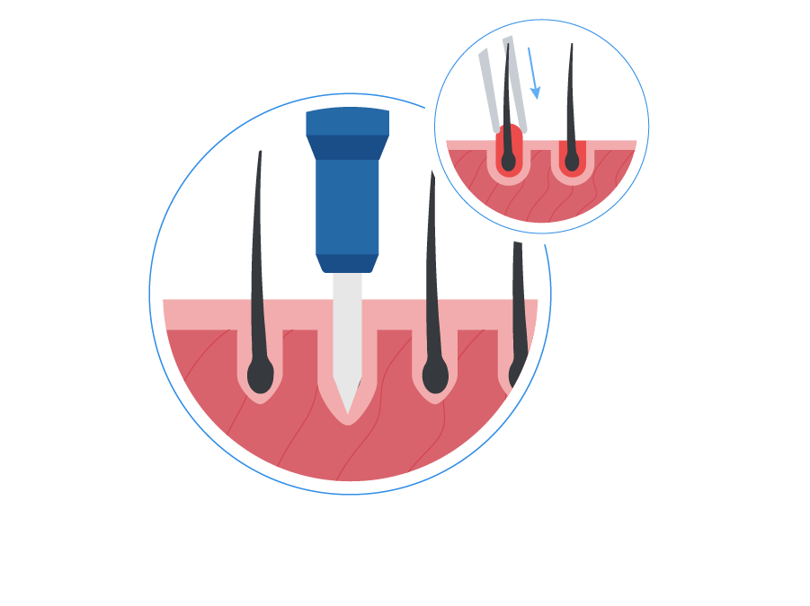 infographic showing a graft transplantation done with the sapphire technique